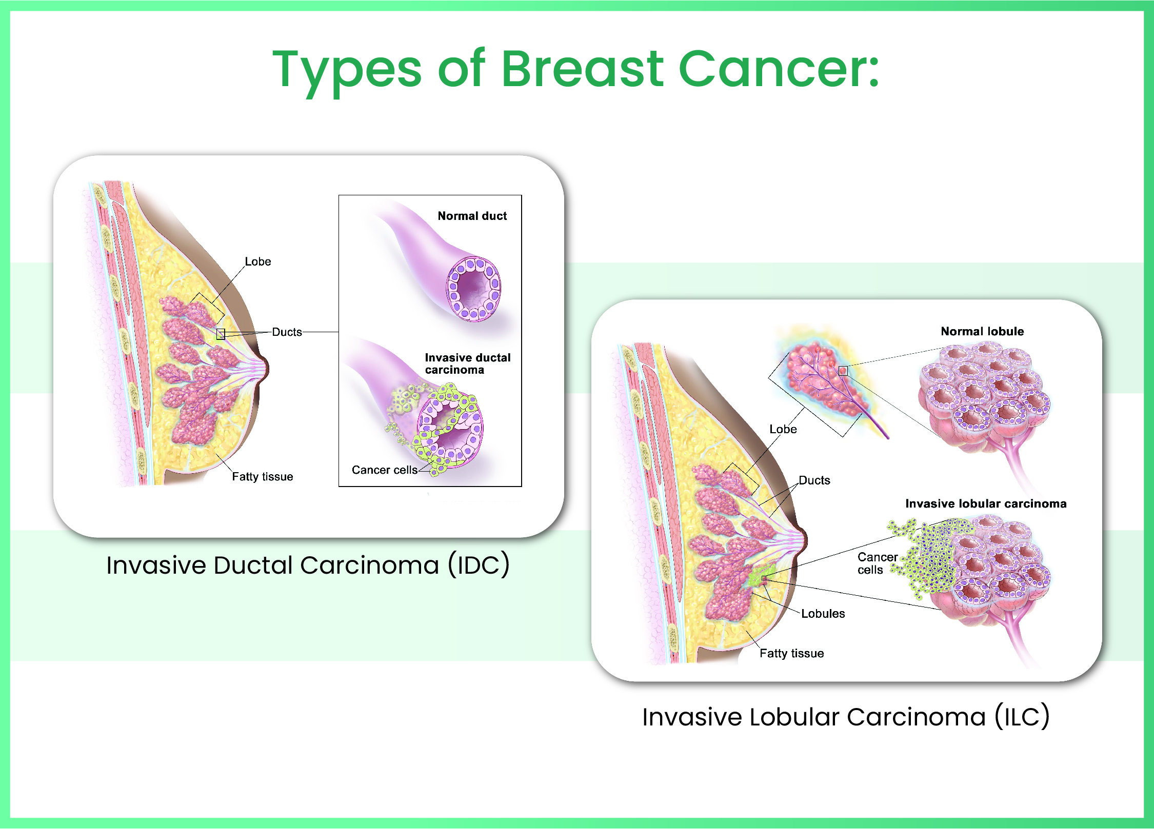 Types of Breast Cancer